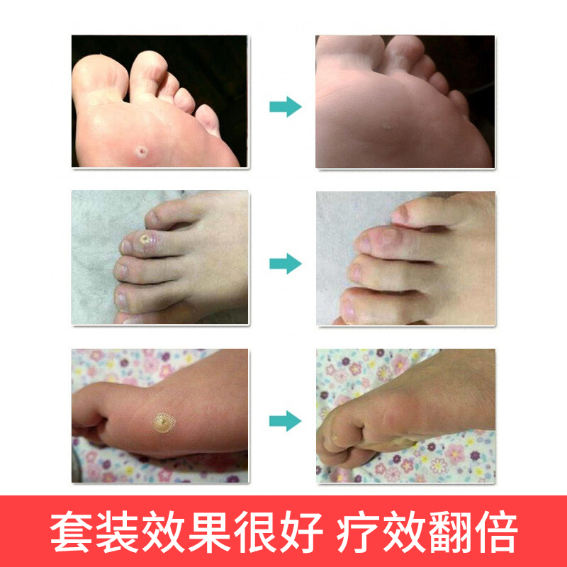 一贴妥 鸡眼膏 鸡眼贴  Ji yan Tie / Yat Tip Tor Corn & Callus Removing Plaster - 12 Plasters - Image 5